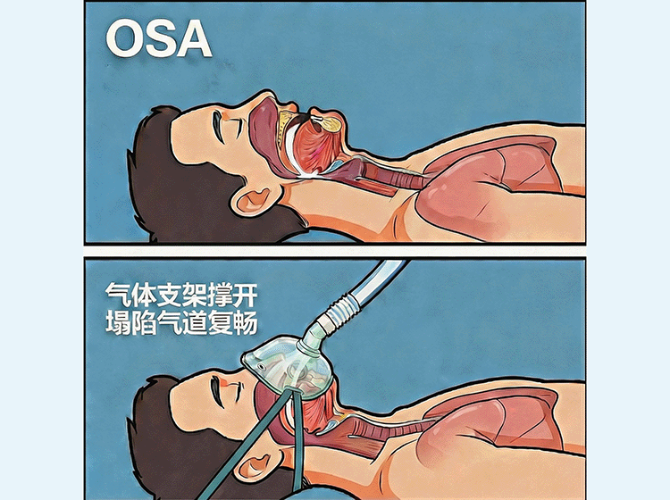 科普 | 呼吸机如何帮你“躺平”睡好？一文教你读懂“黑科技”原理！