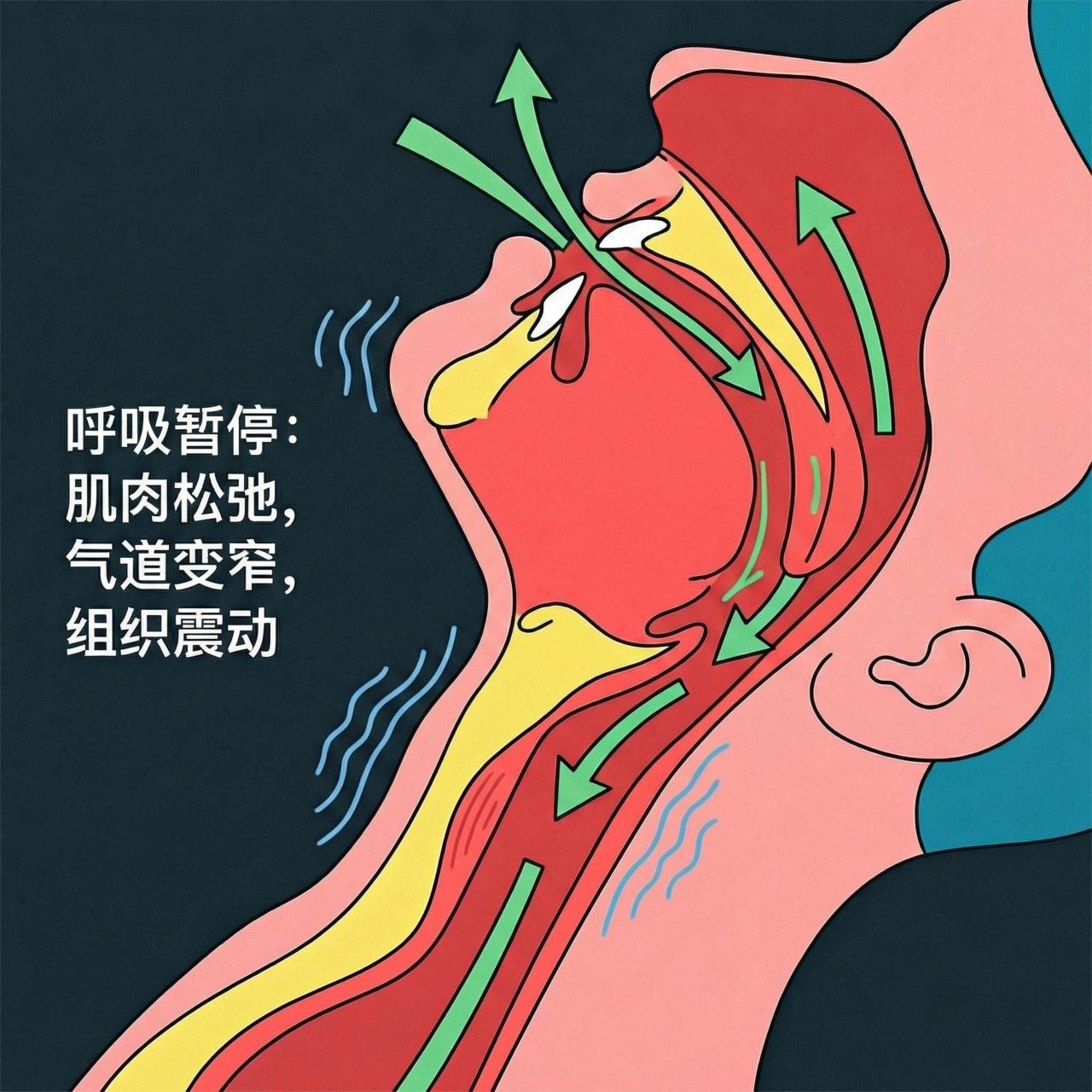 科普 | 打鼾≠睡得香，可能是呼吸暂停在敲门(图6)
