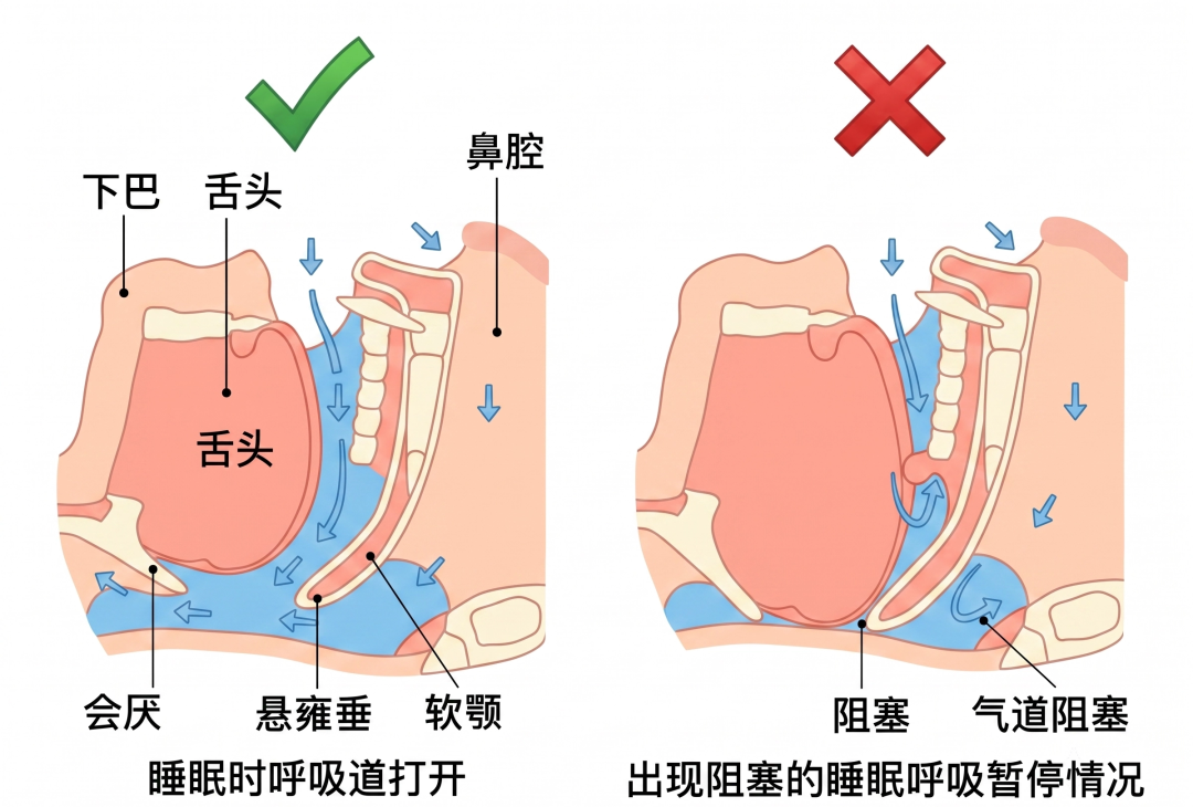 一晚呼吸暂停上百次，TA的身体在经历什么？(图3)